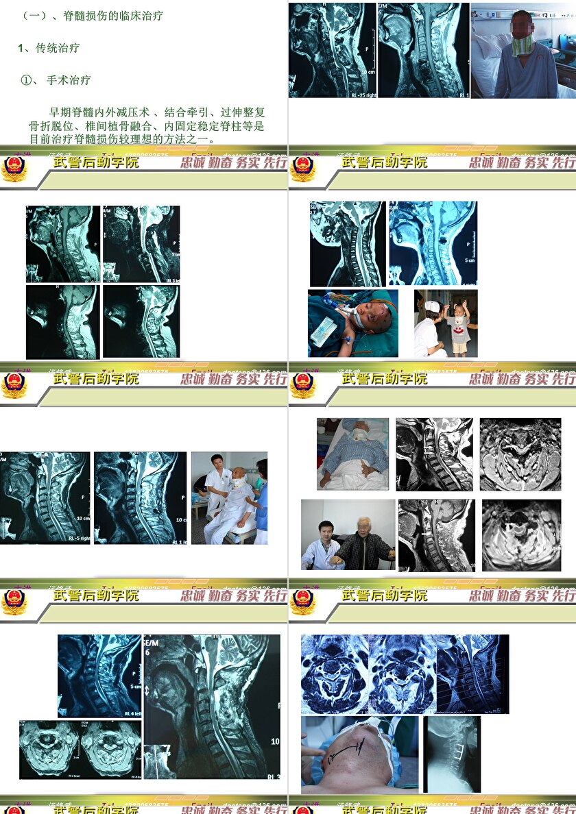 2023年脊髓損傷研究新進(jìn)展，里程碑式的突破與日常奇妙變化